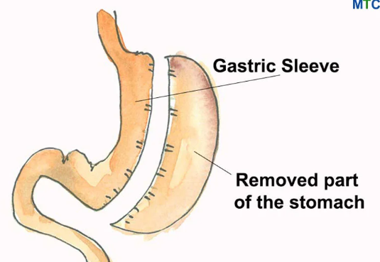 Gastric Sleeve in Tijuana, Mexico: Your Path to Health post thumbnail image