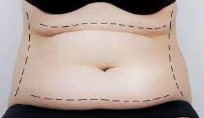 Why Miami is the Go-To City for Tummy Tuck Surgeries post thumbnail image