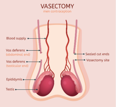 Breaking Barriers to Parenthood: Vasectomy Reversal Options in Saskatoon post thumbnail image