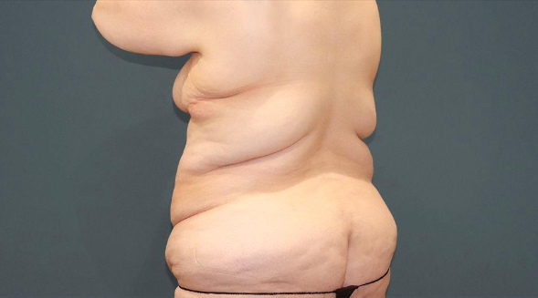 Achieve Your Dream Body with Levant Liposuction post thumbnail image