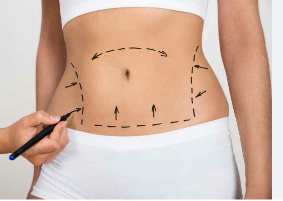 Miami Tummy Tuck Tales: Before and After Success Stories post thumbnail image
